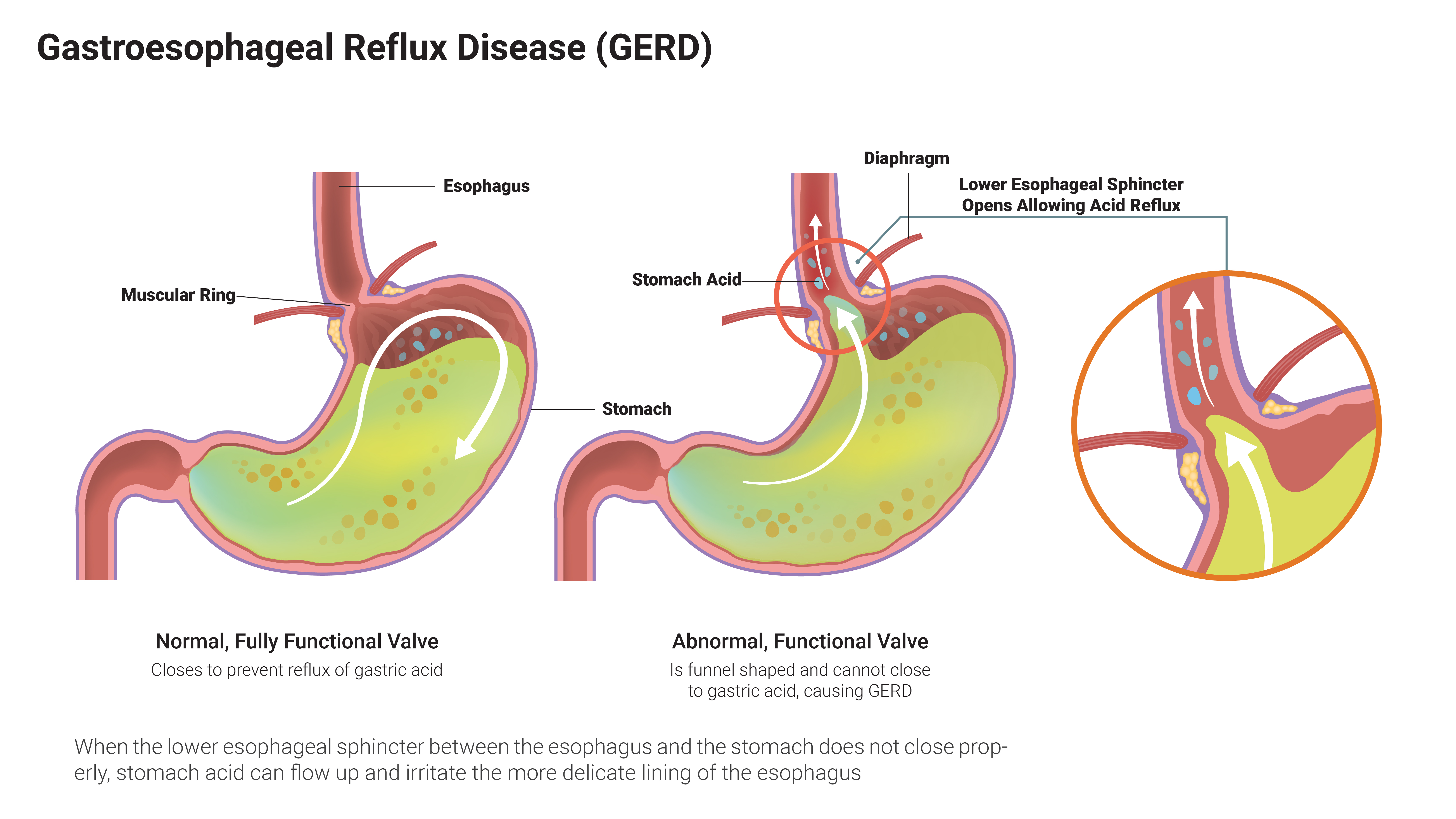 Acid Reflux: The Causes and Treatments | The Surgical Clinic in TN