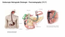 Endoscopic Retrograde Cholangio - Pancreatography (ERCP)