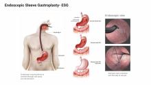 Endoscopic Sleeve Gastroplasty- ESG