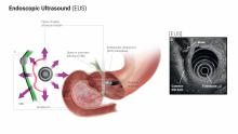 Endoscopic Ultrasound (EUS)