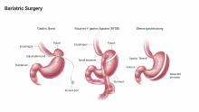 Bariatric Surgery