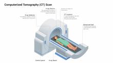Computerized Tomography (CT) Scan